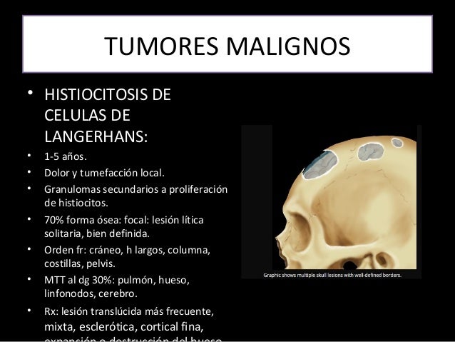 histiocitosis de celulas de langerhans pediatria